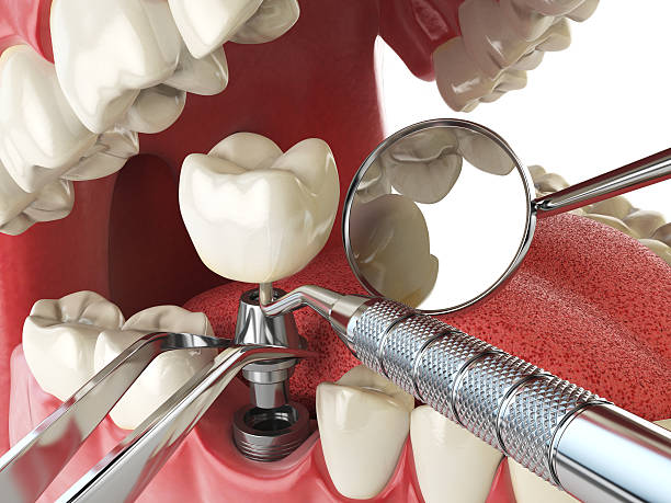 Best Emergency Treatment for Dental Infections or Abscesses in Floresville, TX